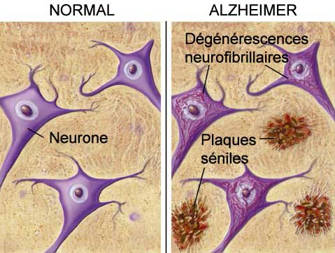 [ Les lésions de la maladie d'Alzheimer.]